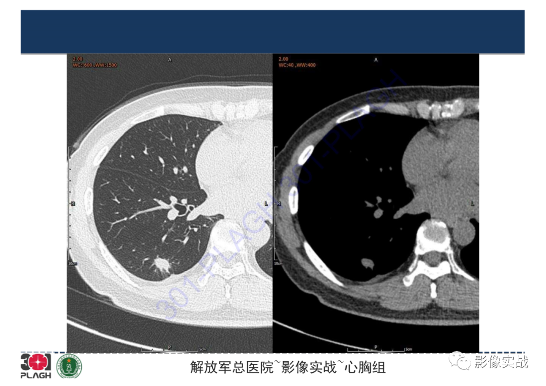 影像PPT - 【病例】肺炎性肌纤维母细胞瘤1例CT影像-13