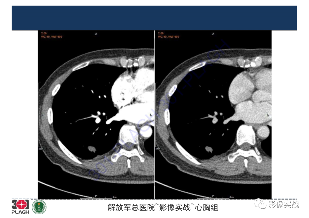 影像PPT - 【病例】肺炎性肌纤维母细胞瘤1例CT影像-14