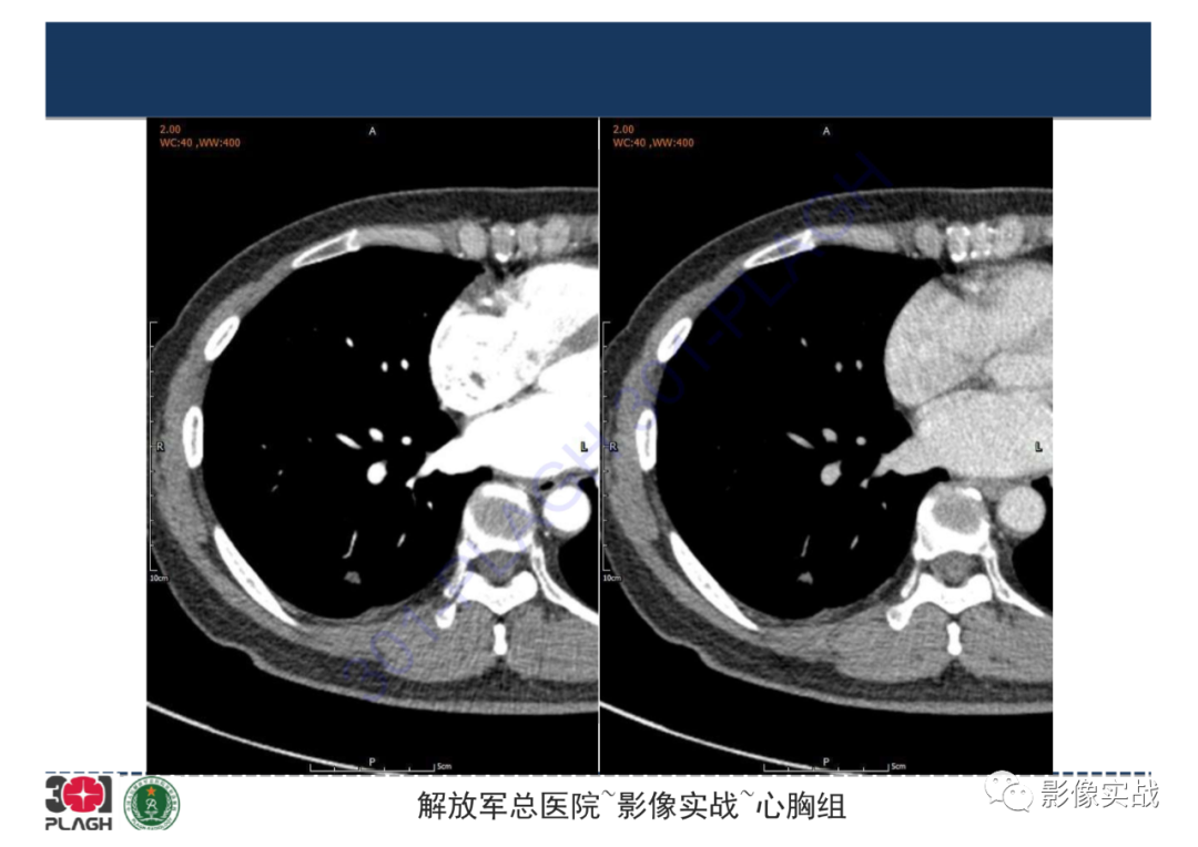 影像PPT - 【病例】肺炎性肌纤维母细胞瘤1例CT影像-16