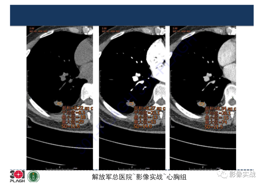 影像PPT - 【病例】肺炎性肌纤维母细胞瘤1例CT影像-17