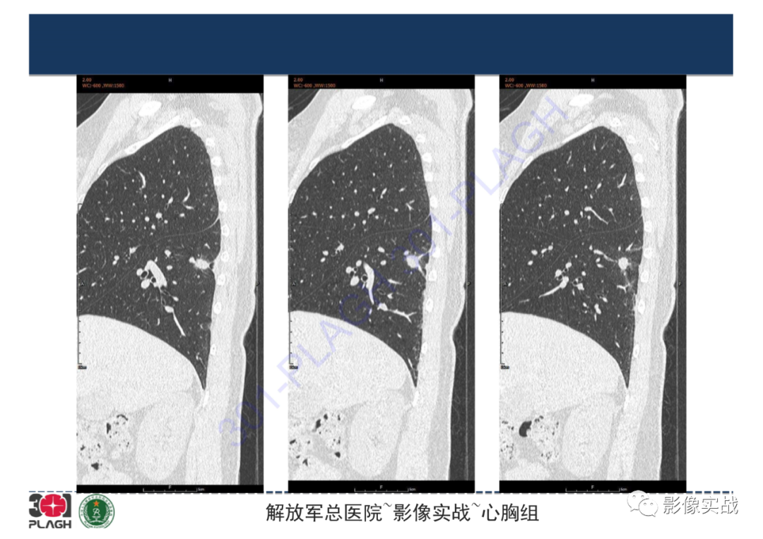 影像PPT - 【病例】肺炎性肌纤维母细胞瘤1例CT影像-18