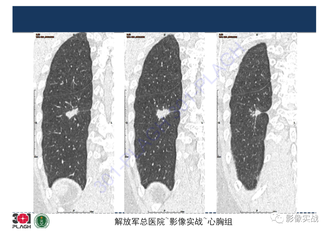 影像PPT - 【病例】肺炎性肌纤维母细胞瘤1例CT影像-19