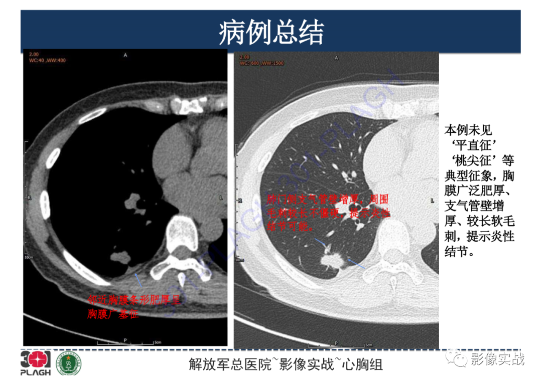 影像PPT - 【病例】肺炎性肌纤维母细胞瘤1例CT影像-24