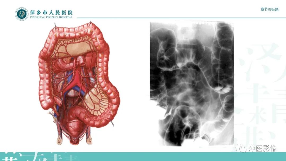 影像PPT - 【PPT】肠梗阻读片之小肠篇-6