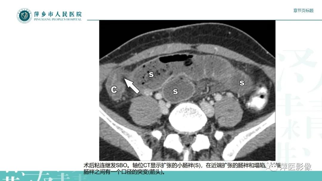 影像PPT - 【PPT】肠梗阻读片之小肠篇-19