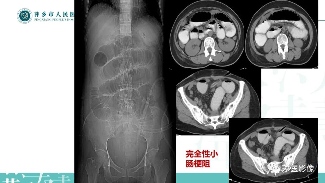 影像PPT - 【PPT】肠梗阻读片之小肠篇-24