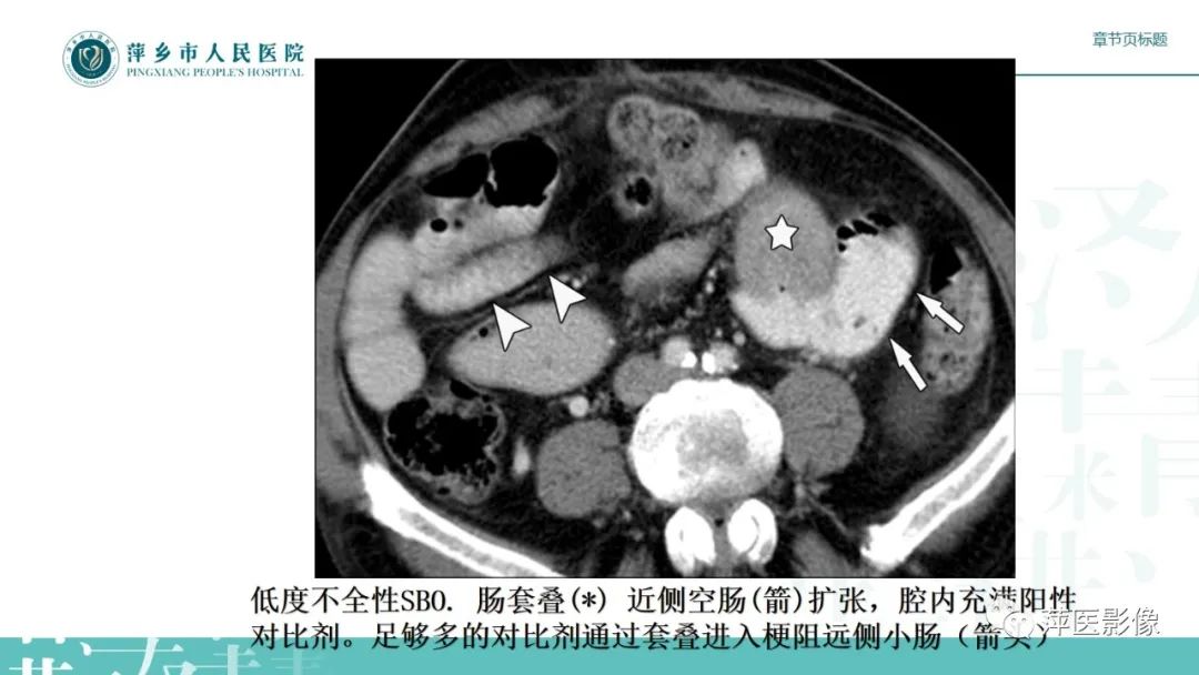 影像PPT - 【PPT】肠梗阻读片之小肠篇-25