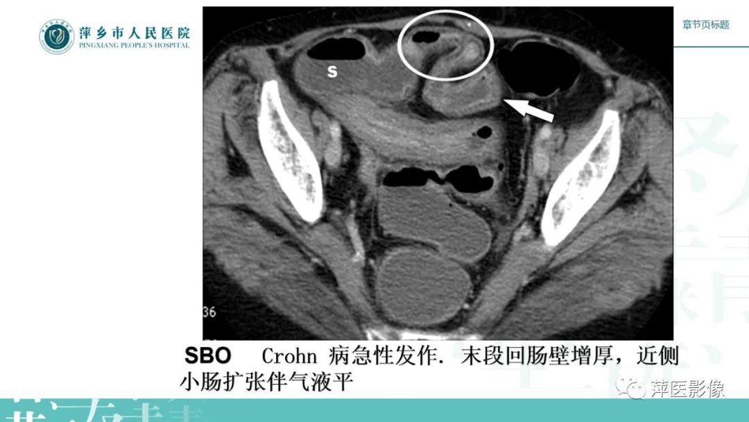 影像PPT - 【PPT】肠梗阻读片之小肠篇-30
