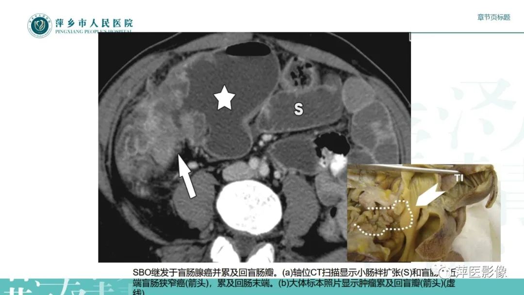 影像PPT - 【PPT】肠梗阻读片之小肠篇-31