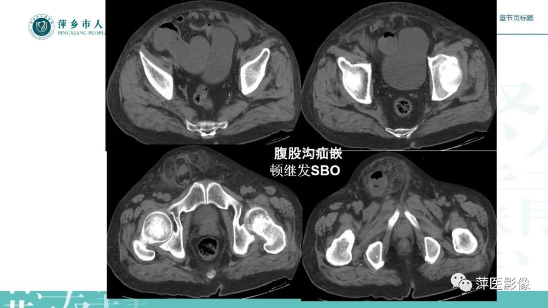 影像PPT - 【PPT】肠梗阻读片之小肠篇-32