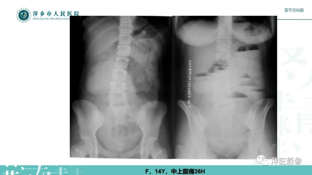 影像PPT - 【PPT】肠梗阻读片之小肠篇-33