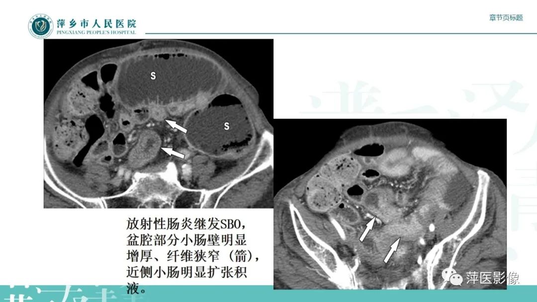 影像PPT - 【PPT】肠梗阻读片之小肠篇-35