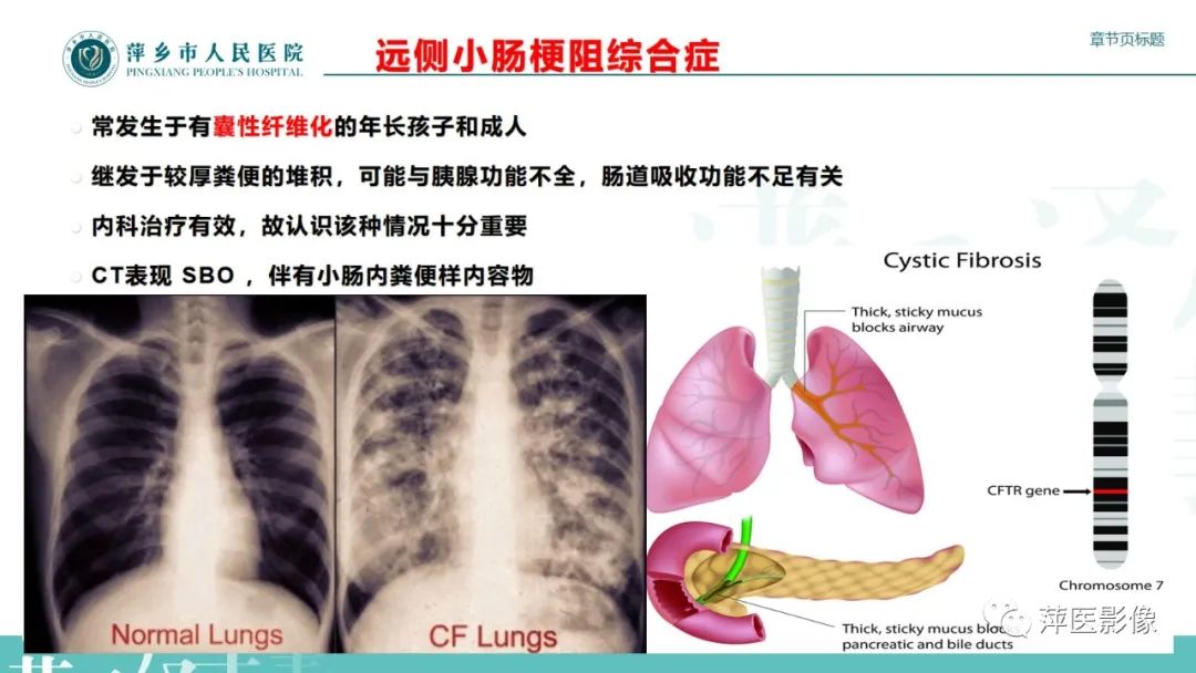 影像PPT - 【PPT】肠梗阻读片之小肠篇-36