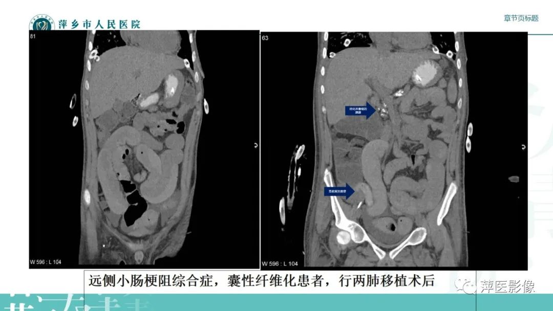 影像PPT - 【PPT】肠梗阻读片之小肠篇-37