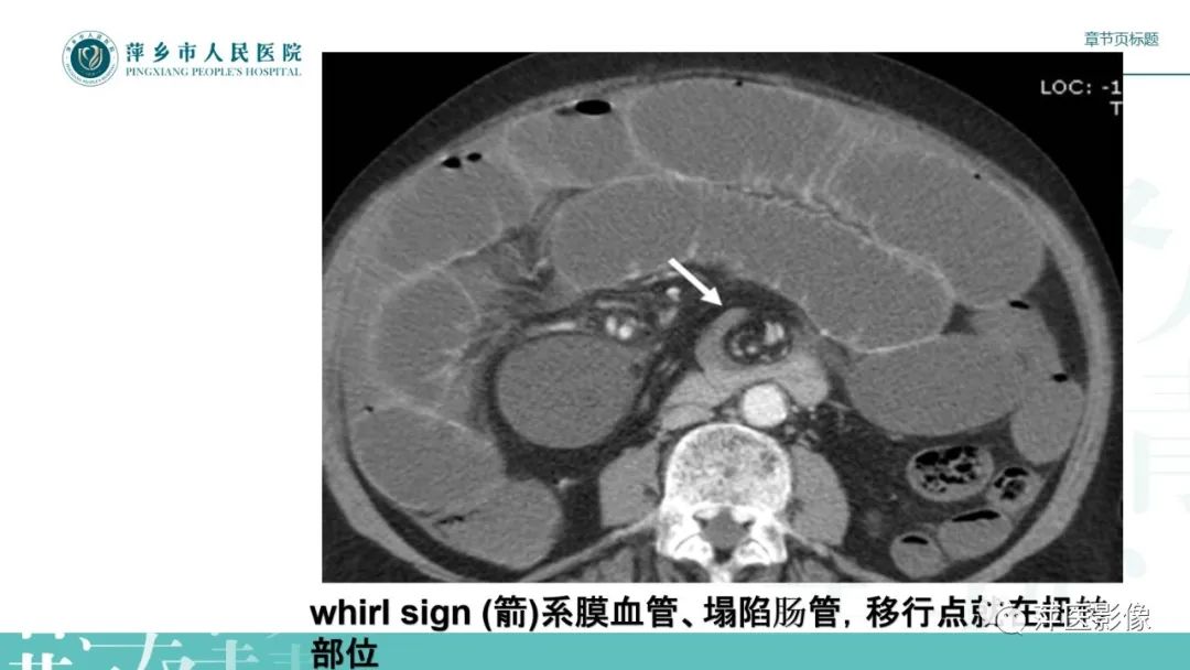 影像PPT - 【PPT】肠梗阻读片之小肠篇-43