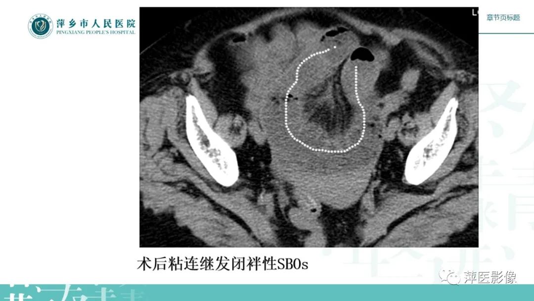 影像PPT - 【PPT】肠梗阻读片之小肠篇-41