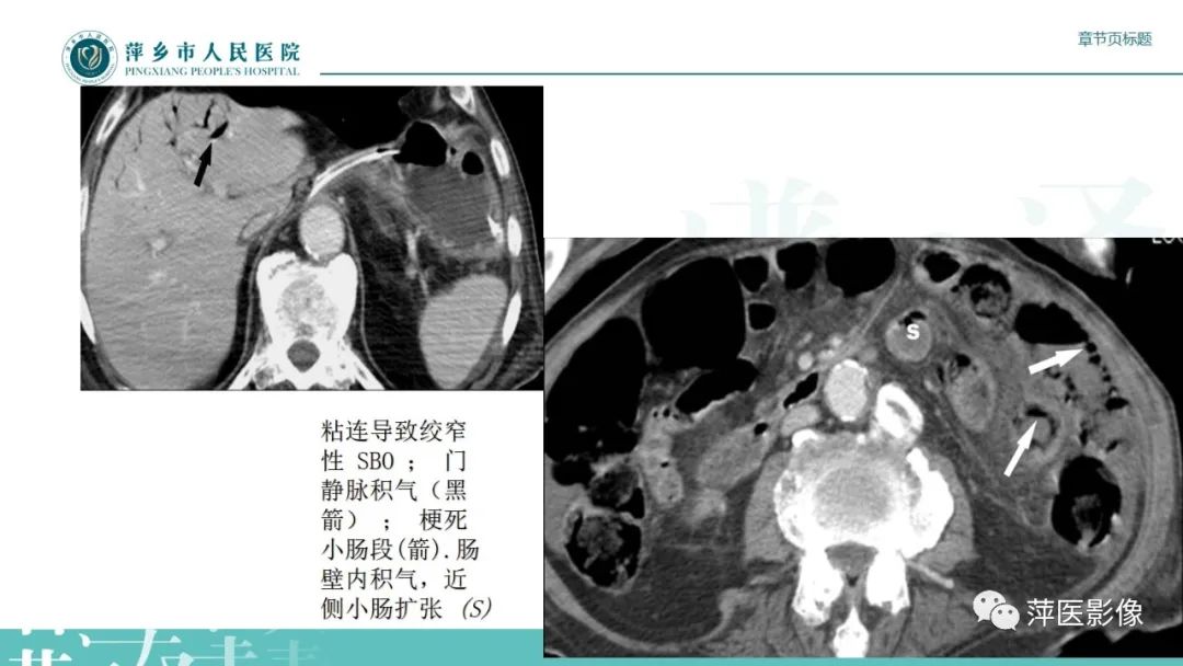影像PPT - 【PPT】肠梗阻读片之小肠篇-46