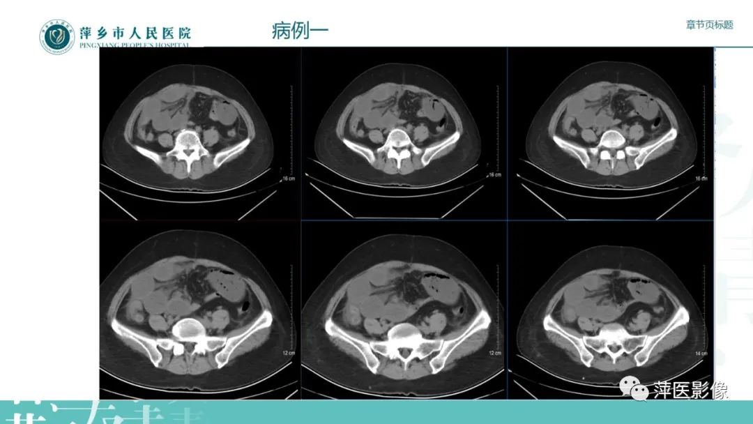 影像PPT - 【PPT】肠梗阻读片之小肠篇-51