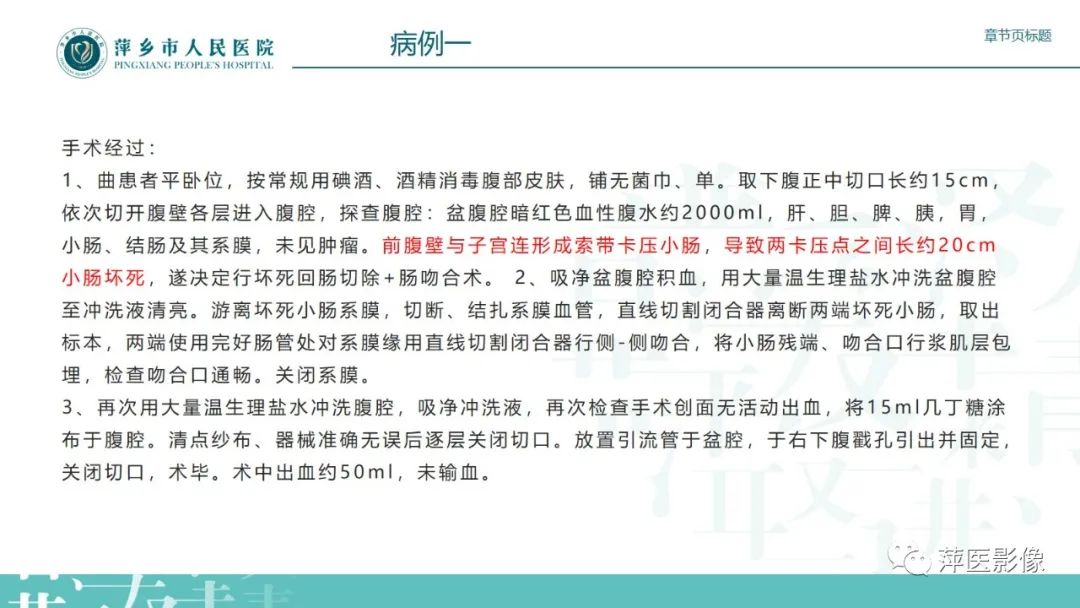 影像PPT - 【PPT】肠梗阻读片之小肠篇-52