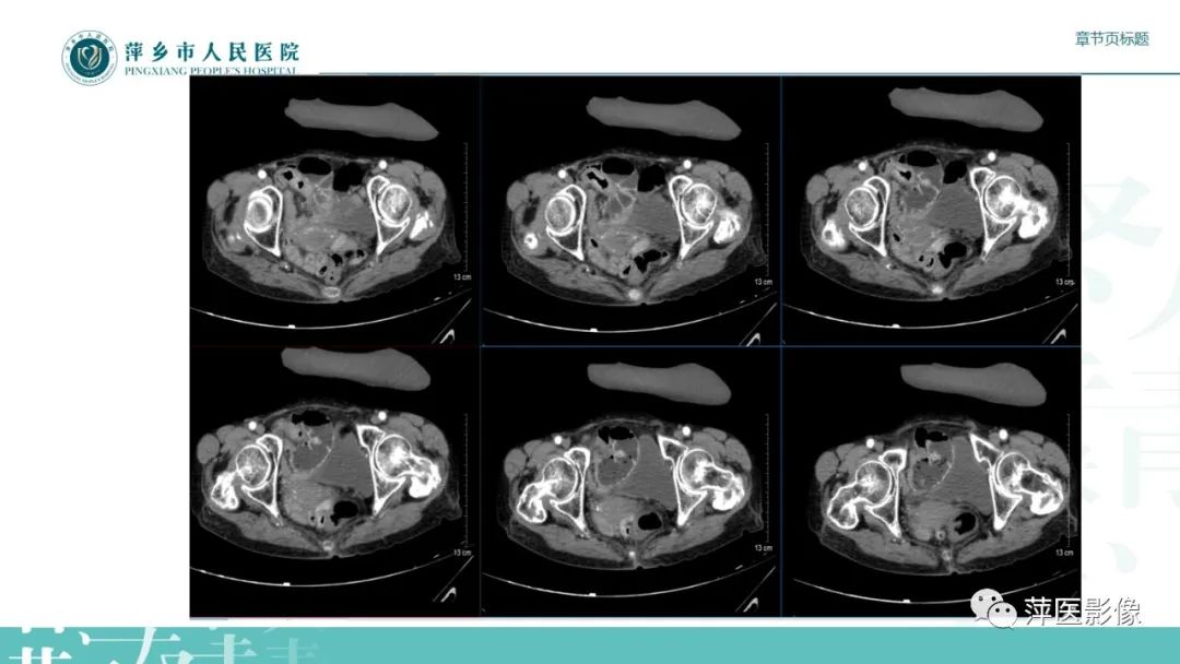 影像PPT - 【PPT】肠梗阻读片之小肠篇-54