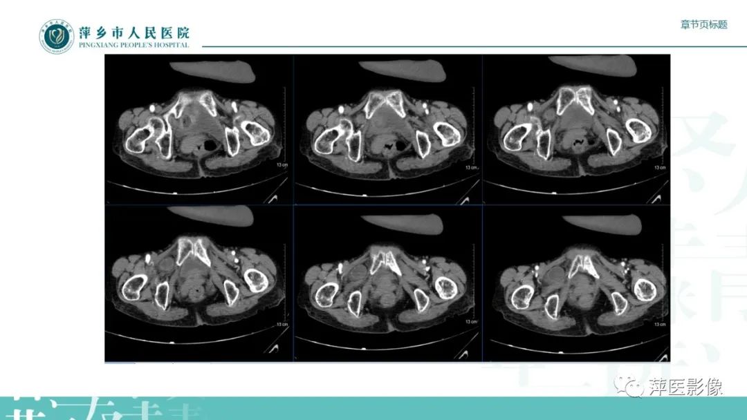 影像PPT - 【PPT】肠梗阻读片之小肠篇-55