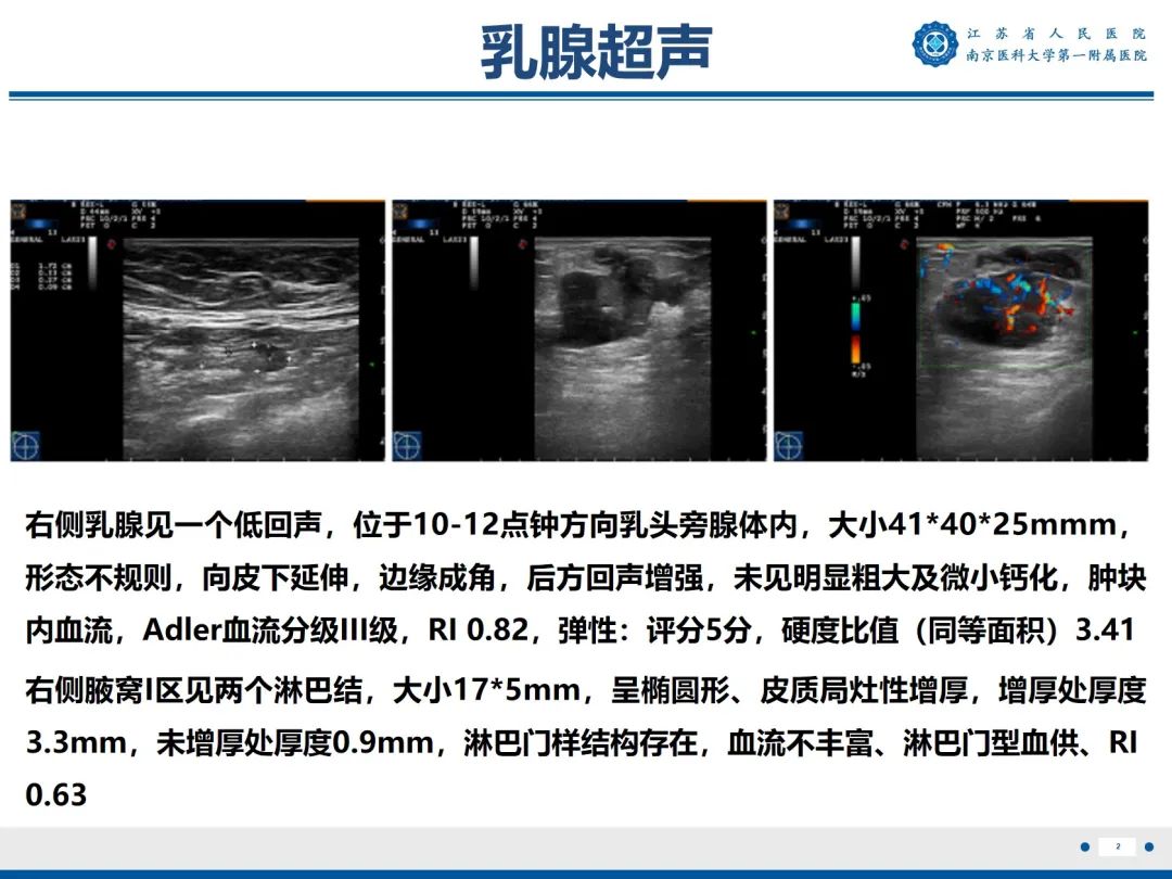 影像PPT - 【PPT】浸润性乳腺癌，非特殊类型-3