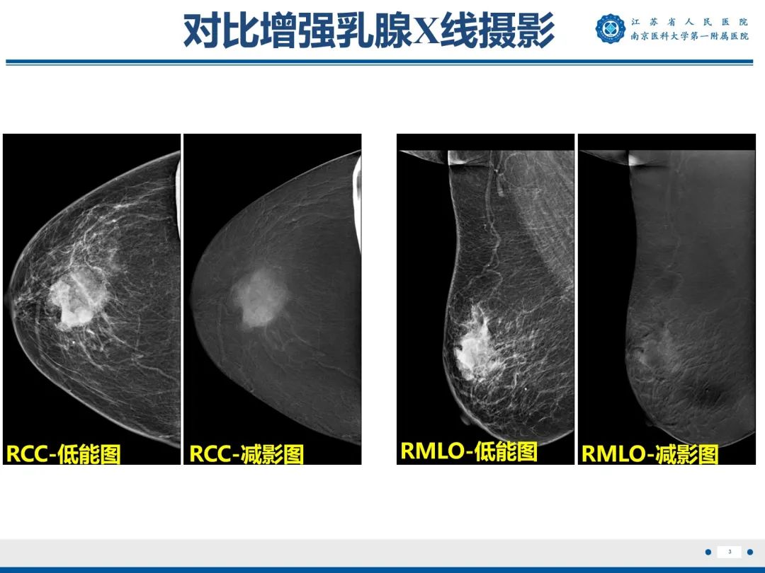 影像PPT - 【PPT】浸润性乳腺癌，非特殊类型-4