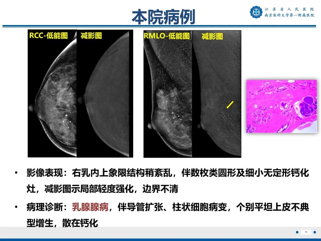 影像PPT - 【PPT】浸润性乳腺癌，非特殊类型-12