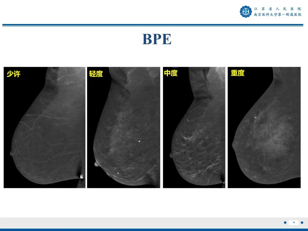 影像PPT - 【PPT】浸润性乳腺癌，非特殊类型-16