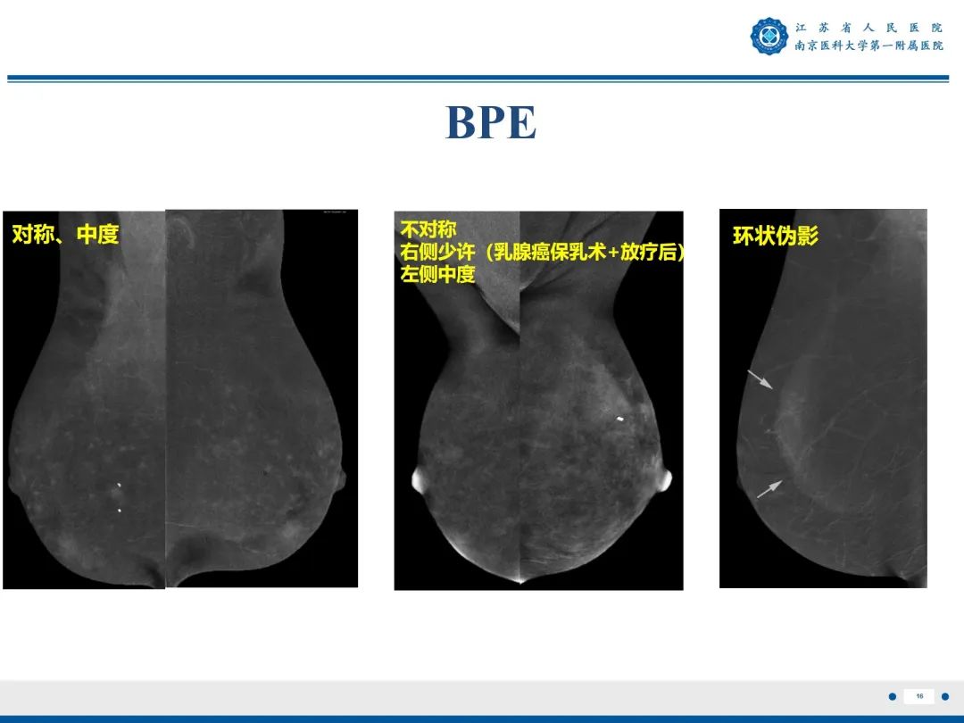 影像PPT - 【PPT】浸润性乳腺癌，非特殊类型-17