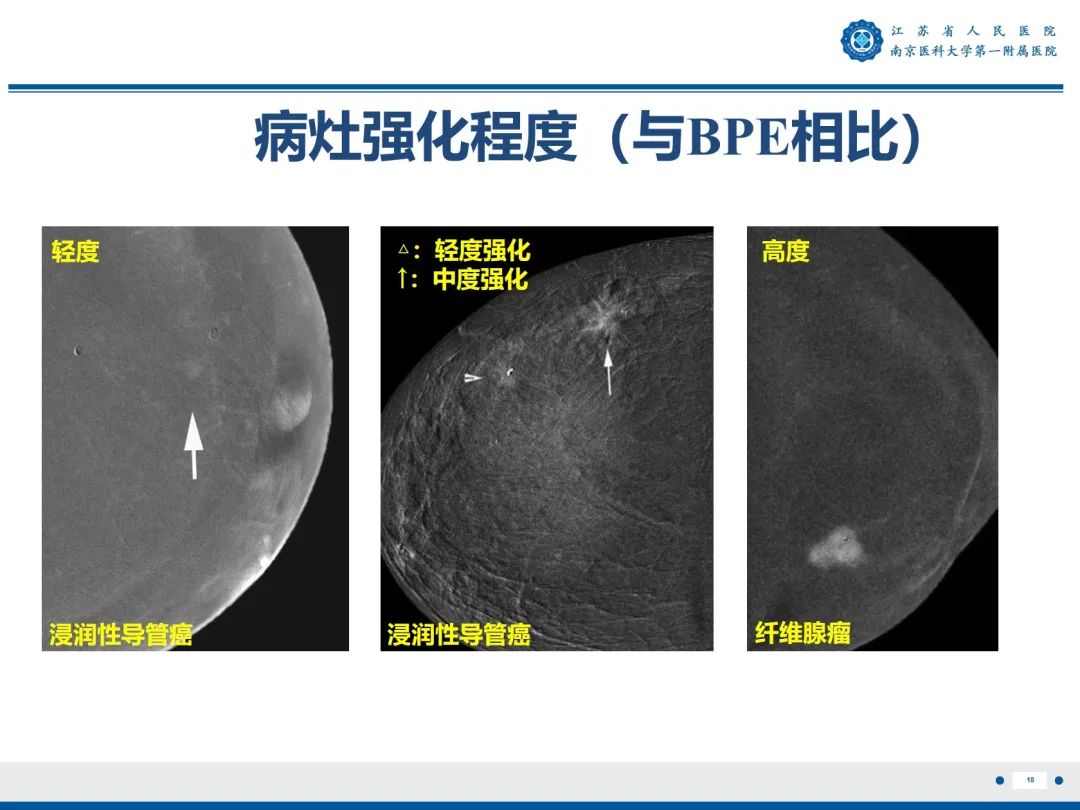 影像PPT - 【PPT】浸润性乳腺癌，非特殊类型-19