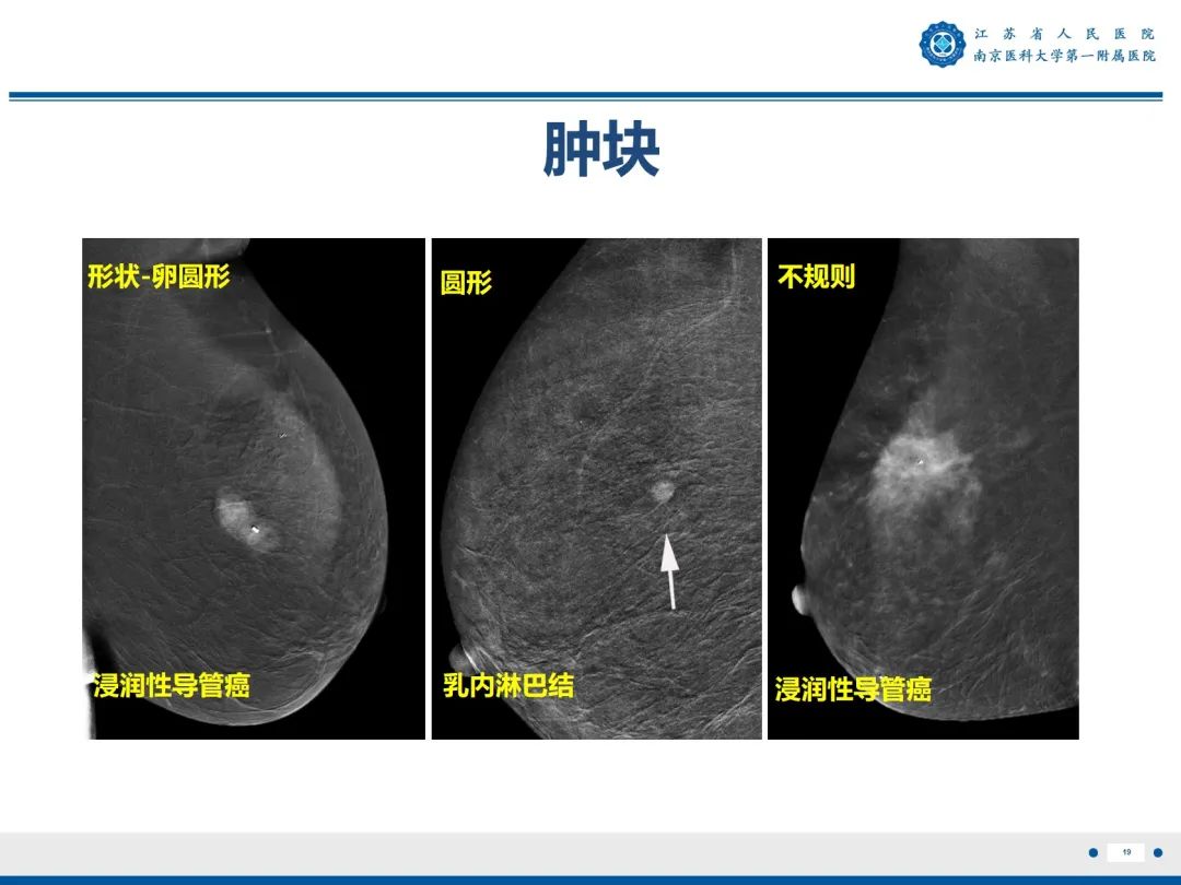 影像PPT - 【PPT】浸润性乳腺癌，非特殊类型-20