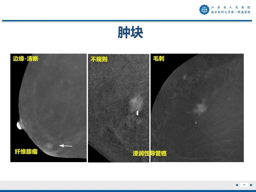 影像PPT - 【PPT】浸润性乳腺癌，非特殊类型-21