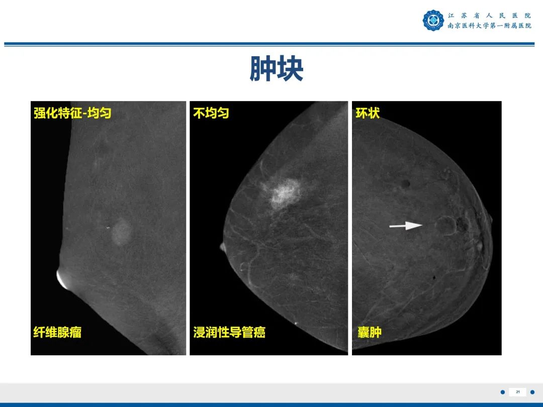影像PPT - 【PPT】浸润性乳腺癌，非特殊类型-22