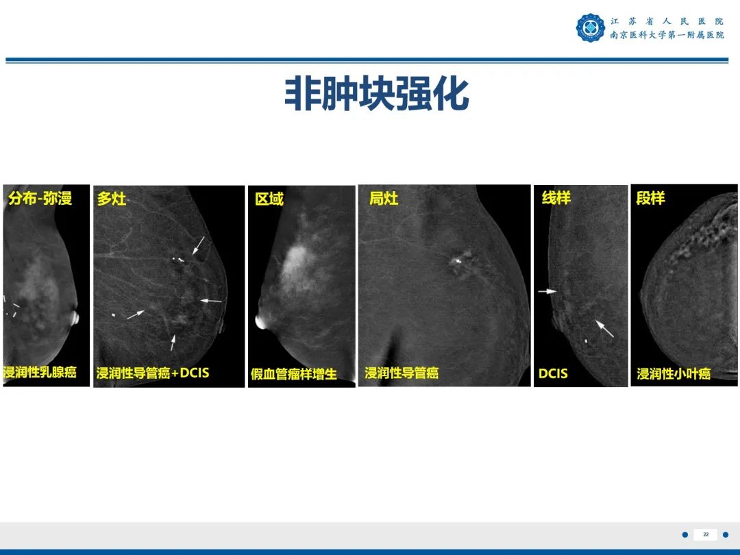 影像PPT - 【PPT】浸润性乳腺癌，非特殊类型-23