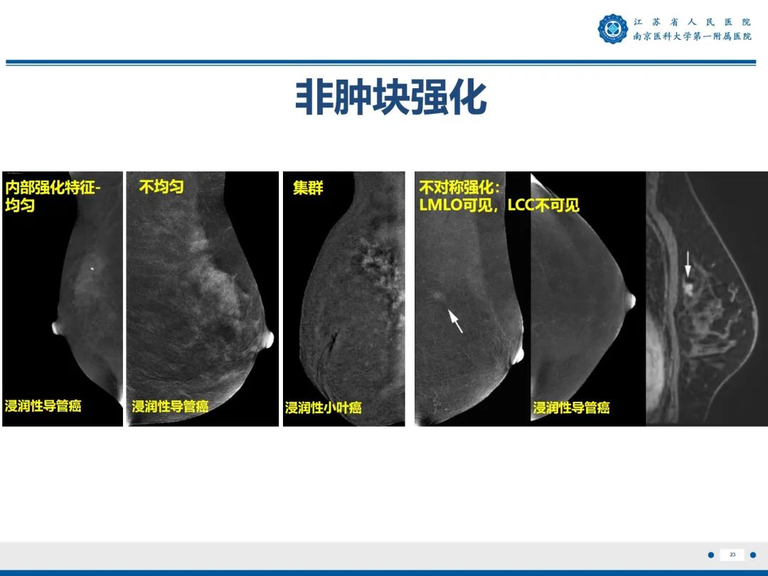 影像PPT - 【PPT】浸润性乳腺癌，非特殊类型-24