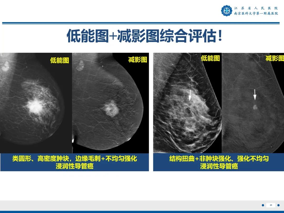 影像PPT - 【PPT】浸润性乳腺癌，非特殊类型-25
