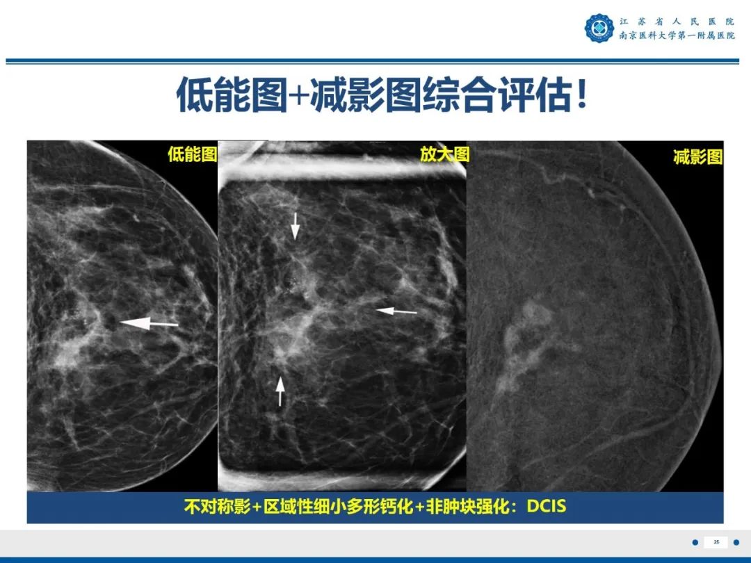 影像PPT - 【PPT】浸润性乳腺癌，非特殊类型-26