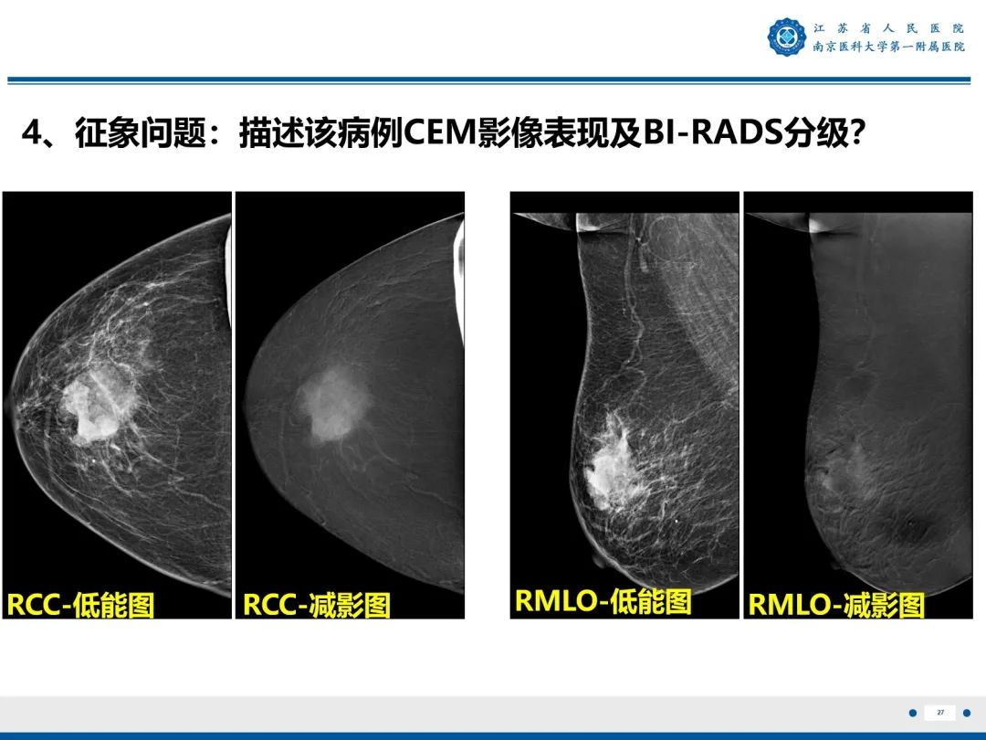 影像PPT - 【PPT】浸润性乳腺癌，非特殊类型-28