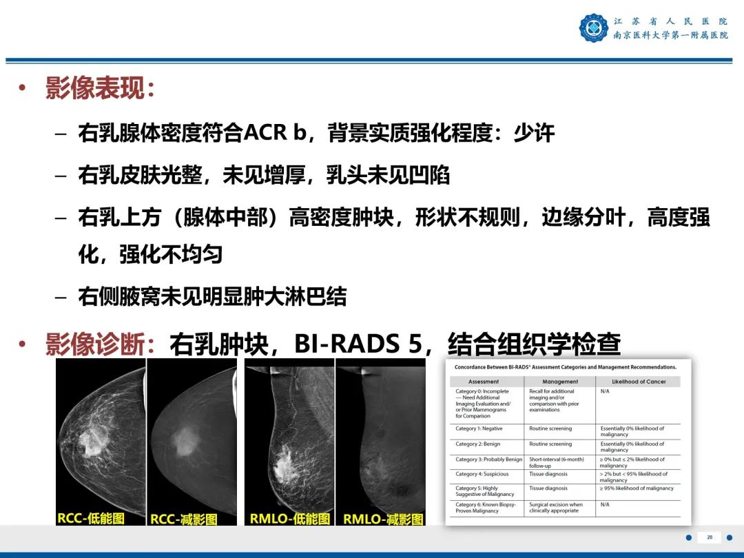 影像PPT - 【PPT】浸润性乳腺癌，非特殊类型-29