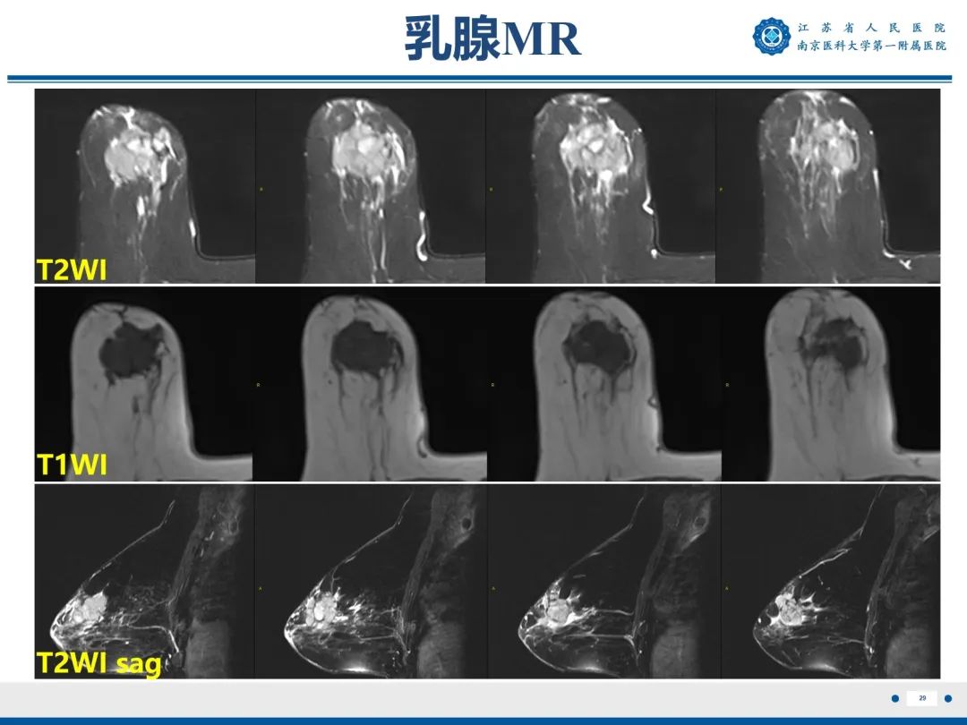 影像PPT - 【PPT】浸润性乳腺癌，非特殊类型-30
