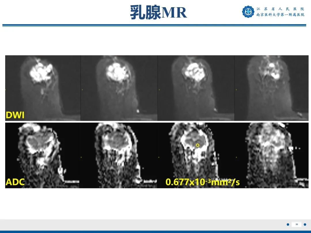 影像PPT - 【PPT】浸润性乳腺癌，非特殊类型-31