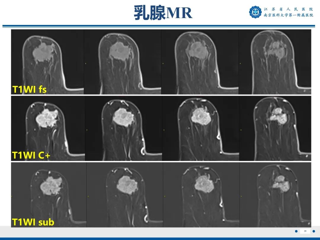 影像PPT - 【PPT】浸润性乳腺癌，非特殊类型-32