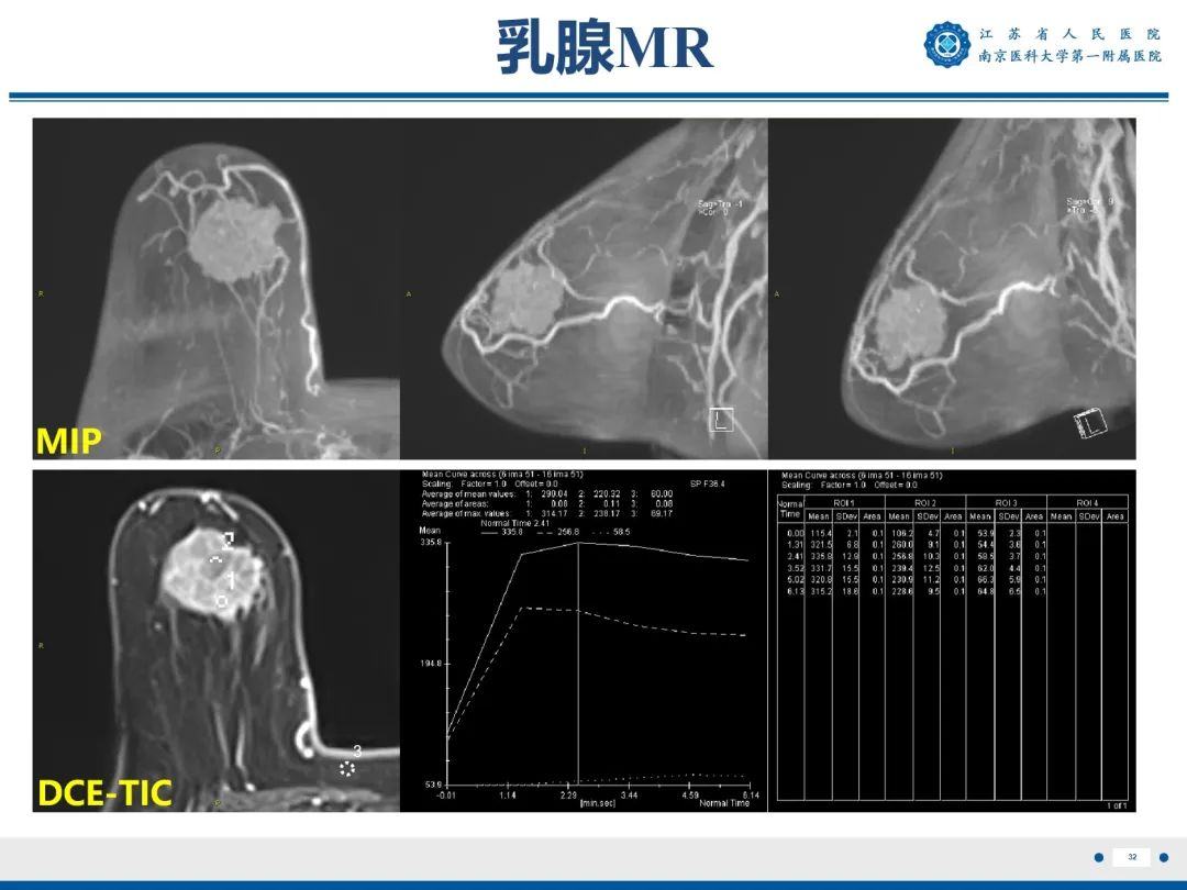 影像PPT - 【PPT】浸润性乳腺癌，非特殊类型-33