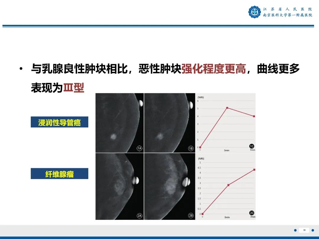 影像PPT - 【PPT】浸润性乳腺癌，非特殊类型-39