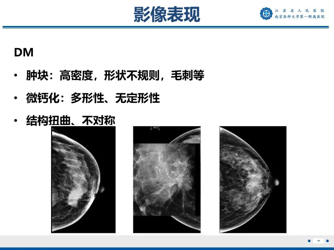 影像PPT - 【PPT】浸润性乳腺癌，非特殊类型-45