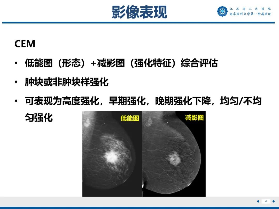 影像PPT - 【PPT】浸润性乳腺癌，非特殊类型-46