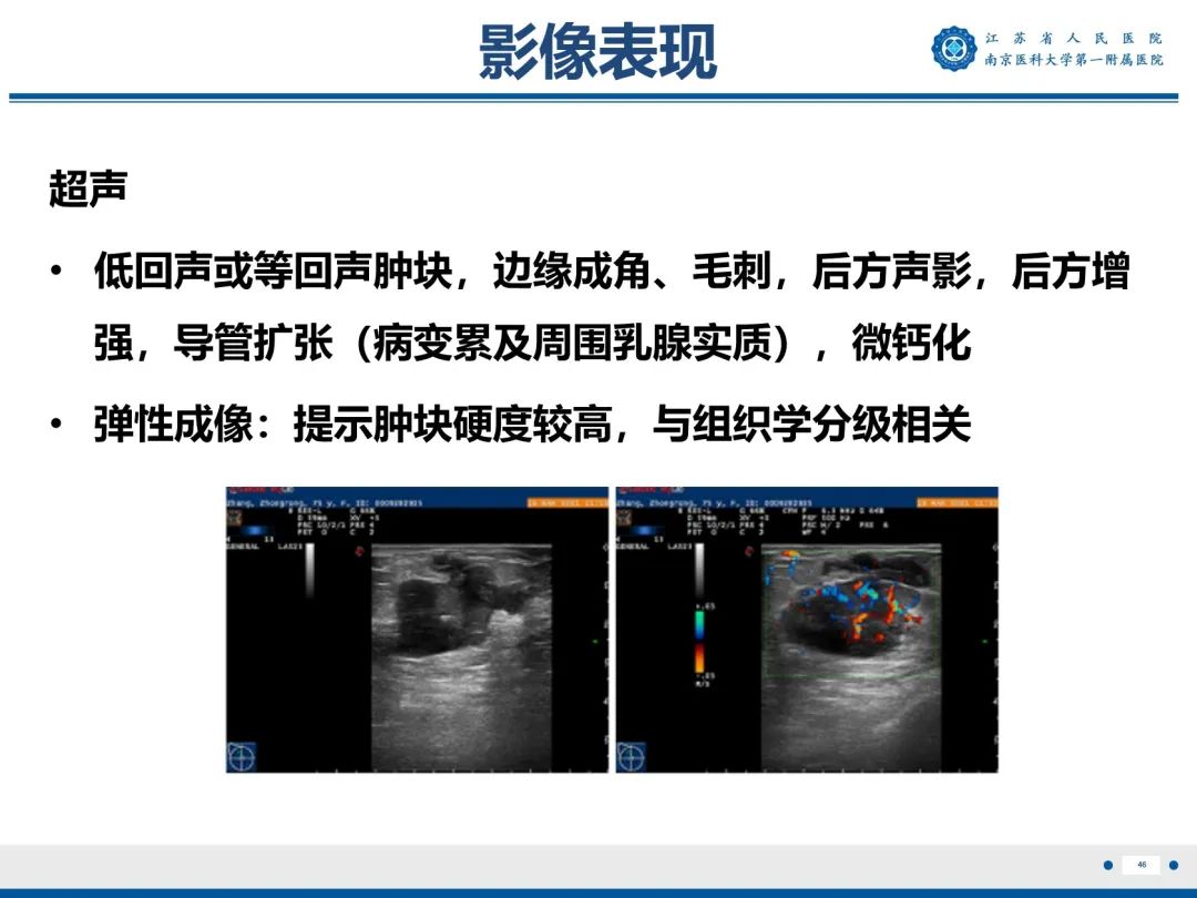 影像PPT - 【PPT】浸润性乳腺癌，非特殊类型-47