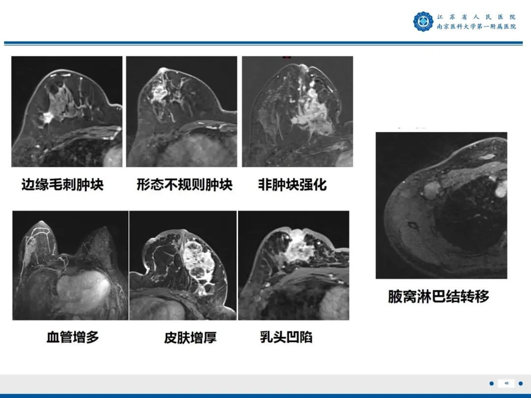 影像PPT - 【PPT】浸润性乳腺癌，非特殊类型-49