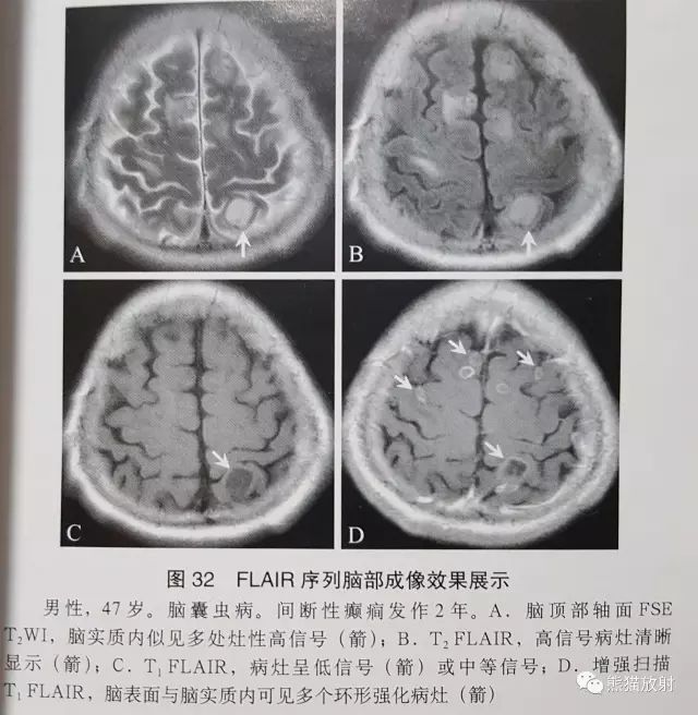 影像PPT - 液体衰减反转恢复(FLAIR)序列图像有何特点-3 影像PPT - 液体衰减反转恢复(FLAIR)序列图像有何特点-3